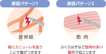 原因パターン1：雑にカニューレを扱うことで傷がつきます　原因パターン2：ふくらはぎなど筋肉の多い箇所で起こります
