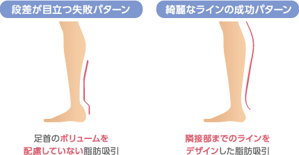 段差が目立つ失敗パターン：足首のボリュームを配慮していない脂肪吸引　綺麗なラインの成功パターン：隣接部までのラインをデザインした脂肪吸引