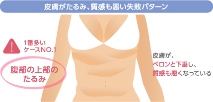 皮膚がたるみ、質感も悪い失敗パターン　1番多いケースNO.1：腹部の上部のたるみ　皮膚が、ペロンと下垂し、質感も悪くなっている