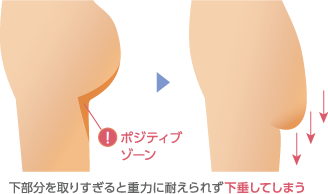 下部分を取りすぎると重力に耐えられず下垂してしまう