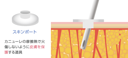 スキンポート：カニューレの摩擦熱で火傷しないように皮膚を保護する道具