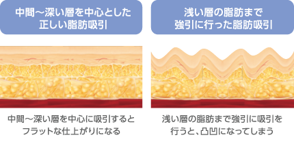 中間〜深い層を中心とした正しい脂肪吸引 中間～深い層を中心に吸引するとフラットな仕上がりになる→OK　浅い層の脂肪まで強引に行った脂肪吸引 浅い層の脂肪まで強引に吸引を行うと、凸凹になってしまう→NG