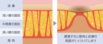 癒着すると筋肉と皮膚がくっついてしまう