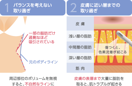 1.バランスを考えない取り過ぎ 周辺部位のボリュームを無視すると、不自然なラインに　2.皮膚に近い層までの取り過ぎ 皮膚の表層まで大量に脂肪を取ると、肌トラブルが起きる