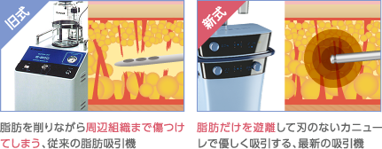 旧式：脂肪を削りながら周辺組織まで傷つけてしまう、従来の脂肪吸引機 新式：脂肪だけを遊離して刃のないカニューレで優しく吸引する、最新の吸引機