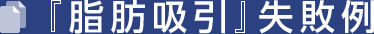 『脂肪吸引』失敗例