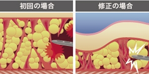 脂肪吸引 2回目
