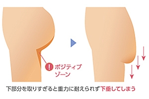 脂肪吸引 お尻 失敗 原因