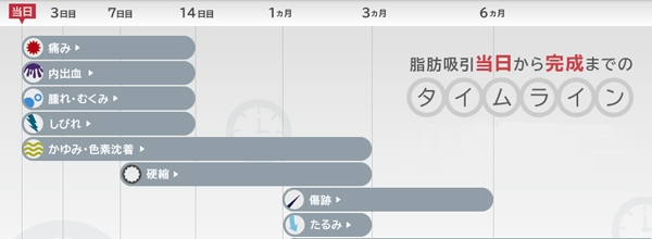 脂肪吸引 ダウンタイム