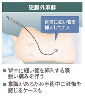 硬膜外麻酔
