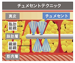 脂肪吸引 麻酔 チュメセント