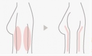 二の腕、脂肪吸引