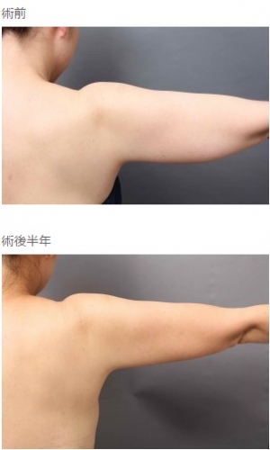 二の腕、脂肪吸引、細い