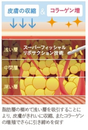 膝、たるみ、ベイザー