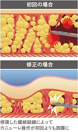 ベイザー脂肪吸引 カニューレ 脂肪吸引