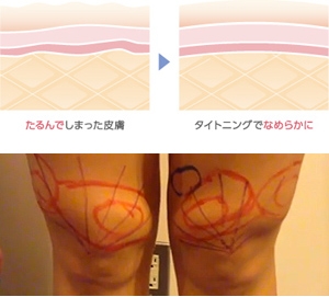 膝 たるみ 引き締め