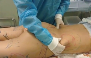 脂肪吸引 腰 術中