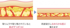 ベイザー脂肪吸引 失敗 治療