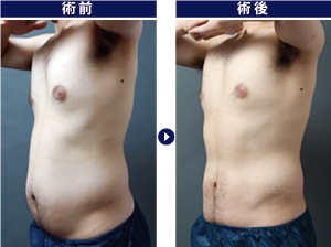 脂肪吸引,男,腹,症例