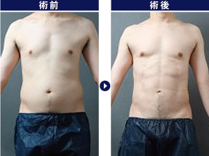 脂肪吸引,男,腹,症例