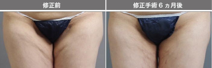 太股 脂肪吸引 失敗修正