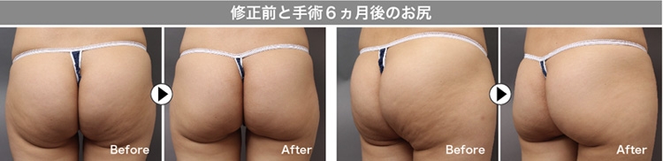 脂肪吸引 修正 実例