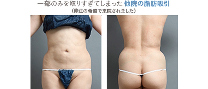 脂肪吸引 腹 失敗