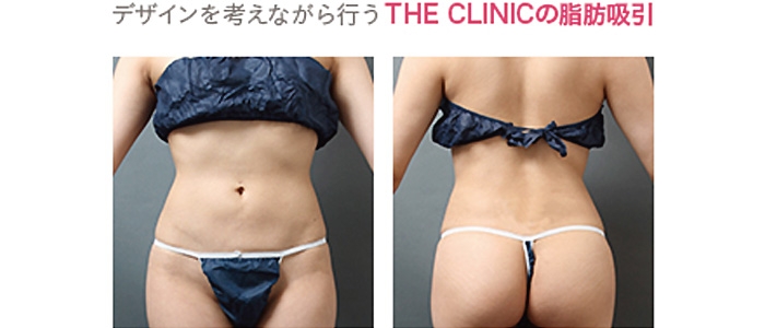脂肪吸引 腹 修正