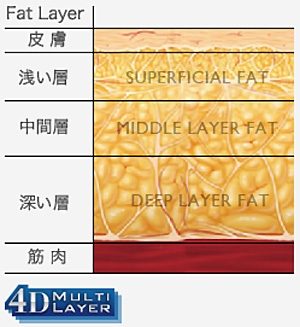 脂肪吸引 失敗しない