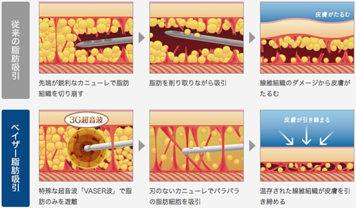 ベイザー脂肪吸引 特徴