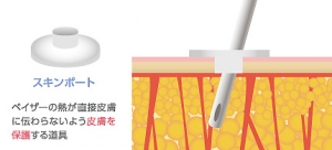 脂肪吸引 傷口 スキンポート