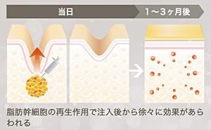 色素沈着 シミ 治療