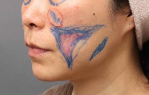 脂肪吸引 頬 失敗 画像