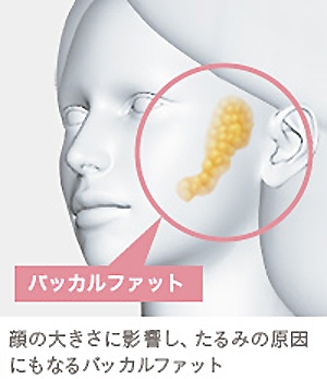 脂肪吸引 バッカルファット