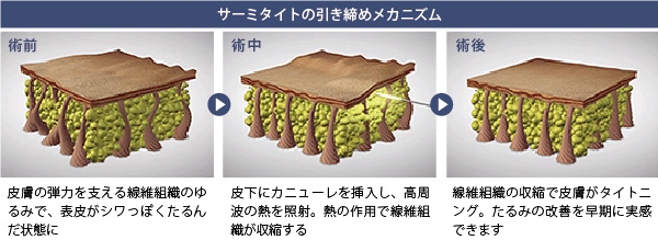 サーミタイト たるみ 引き締め
