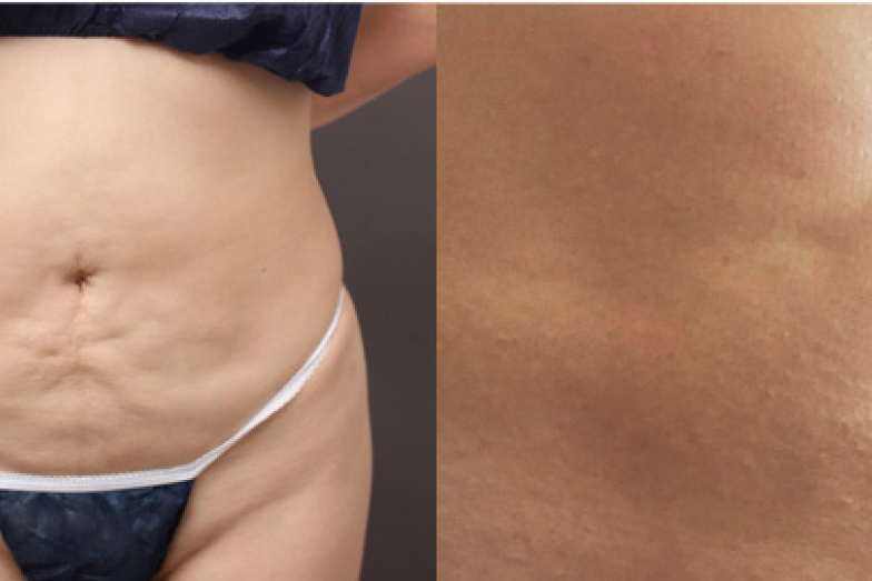 B お腹の脂肪吸引に失敗 凸凹を修正してくびれた腹筋に