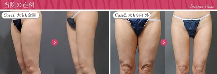 脂肪吸引 太もも 画像