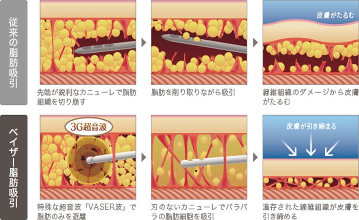 脂肪吸引 ベイザー 超音波