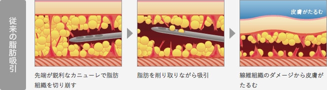 脂肪吸引 機器 デメリット