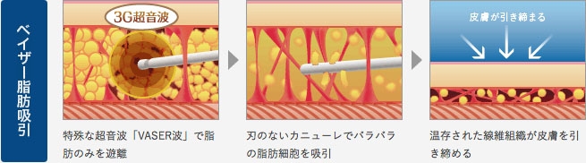 脂肪吸引 ベイザーリポ ベイザー脂肪吸引