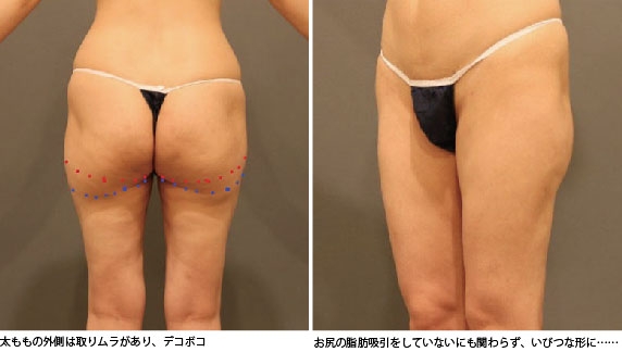 太ももの脂肪吸引の失敗写真