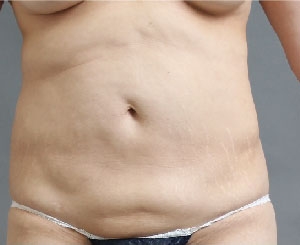 お腹の脂肪吸引の失敗例