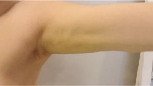 二の腕の脂肪吸引の失敗写真