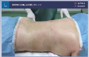背中の脂肪吸引の手術直後