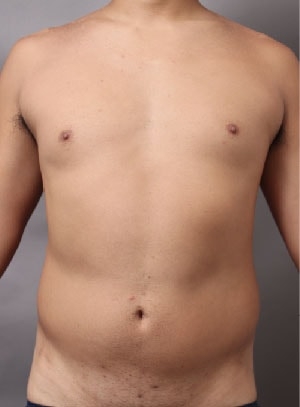 他院の脂肪吸引修正にいらした男性の写真
