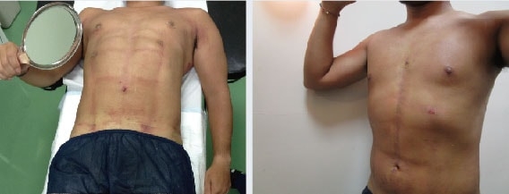 男性の脂肪吸引の術後