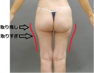 太ももの脂肪吸引の失敗原因を解説