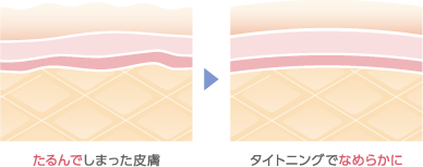 たるんでしまった皮膚→タイトニングでなめらかに