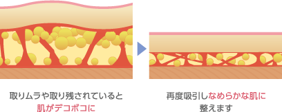 取りムラや取り残されていると肌がデコボコに　再度吸引しなめらかな肌に整えます