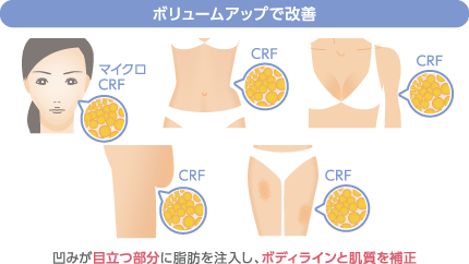 ボリュームアップで改善　凹みが目立つ部分に脂肪を注入し、ボディラインと肌質を補正	